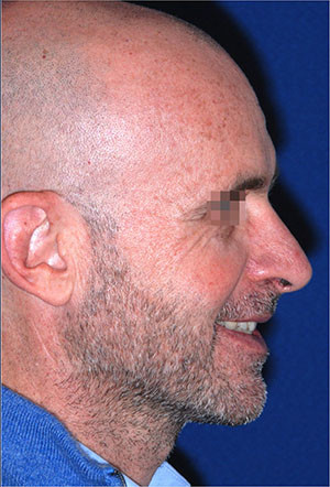 rinoplastica maschile