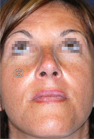 scultura punta del naso