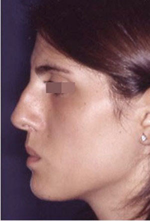revision rhinoplasty