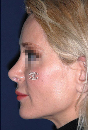 revision rhinoplasty